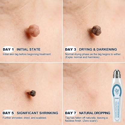 Only 10 left! 🌟 𝐇𝐢𝐬𝐤𝐢𝐧® Wart Removal Roll-On Pen is now 30% off—help reduce the appearance of warts in just 1–3 weeks. Once sold out, it won’t return until next year! 180-day money-back guarantee, completely risk-free.
