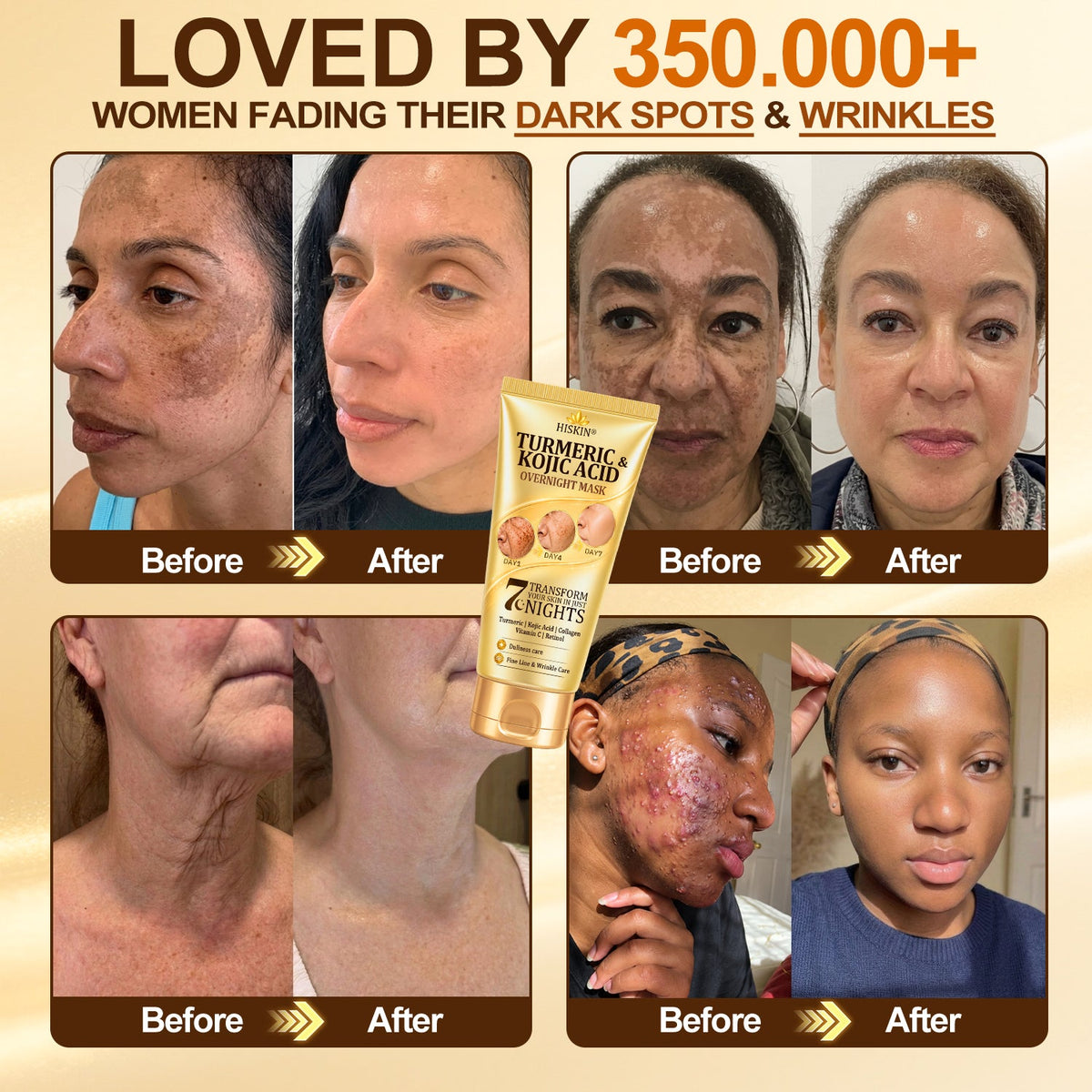 𝑶𝒇𝒇𝒊𝒄𝒊𝒂𝒍 𝑺𝒕𝒐𝒓𝒆 | 𝐍𝐞𝐰! ✨ 𝐇𝐢𝐬𝐤𝐢𝐧® 𝐓𝐮𝐫𝐦𝐞𝐫𝐢𝐜 × 𝐊𝐨𝐣𝐢𝐜 𝐀𝐜𝐢𝐝 𝐎𝐯𝐞𝐫𝐧𝐢𝐠𝐡𝐭 𝐏𝐞𝐞𝐥-𝐎𝐟𝐟 𝐌𝐚𝐬𝐤 — 𝐅𝐚𝐝𝐞 𝐒𝐭𝐮𝐛𝐛𝐨𝐫𝐧 𝐃𝐚𝐫𝐤 𝐒𝐩𝐨𝐭𝐬 & 𝐒𝐦𝐨𝐨𝐭𝐡 𝐕𝐢𝐬𝐢𝐛𝐥𝐞 𝐖𝐫𝐢𝐧𝐤𝐥𝐞𝐬 𝐖𝐡𝐢𝐥𝐞 𝐘𝐨𝐮 𝐒𝐥𝐞𝐞𝐩 🌙✨ 𝐓𝐮𝐫𝐦𝐞𝐫𝐢𝐜 × 𝐊𝐨𝐣𝐢𝐜 𝐀𝐜𝐢𝐝 × 𝐏𝐞𝐩𝐭𝐢𝐝𝐞𝐬 ✅ 𝐎𝐧𝐞 𝐒𝐭𝐞𝐩 𝐚 𝐍𝐢𝐠𝐡𝐭 · 𝐕𝐢𝐬𝐢𝐛𝐥𝐞 𝐂𝐡𝐚𝐧𝐠𝐞𝐬 𝐢𝐧 𝟕 𝐍𝐢𝐠𝐡𝐭𝐬 💯